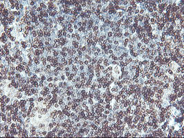 APMAP / C20orf3 Antibody - IHC of paraffin-embedded Human lymphoma tissue using anti-C20orf3 mouse monoclonal antibody. (Heat-induced epitope retrieval by 10mM citric buffer, pH6.0, 100C for 10min).
