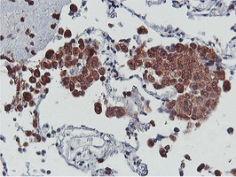 APMAP / C20orf3 Antibody - IHC of paraffin-embedded Carcinoma of Human lung tissue using anti-C20orf3 mouse monoclonal antibody.