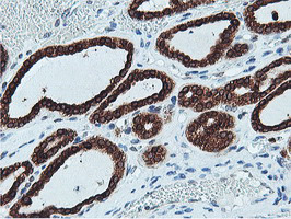 APMAP / C20orf3 Antibody - IHC of paraffin-embedded Carcinoma of Human thyroid tissue using anti-C20orf3 mouse monoclonal antibody.