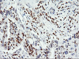 APMAP / C20orf3 Antibody - IHC of paraffin-embedded Carcinoma of Human pancreas tissue using anti-C20orf3 mouse monoclonal antibody.