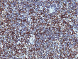 APMAP / C20orf3 Antibody - IHC of paraffin-embedded Human lymphoma tissue using anti-C20orf3 mouse monoclonal antibody.