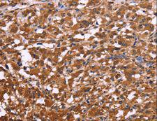APMAP / C20orf3 Antibody - Immunohistochemistry of paraffin-embedded Human thyroid cancer using APMAP Polyclonal Antibody at dilution of 1:30.