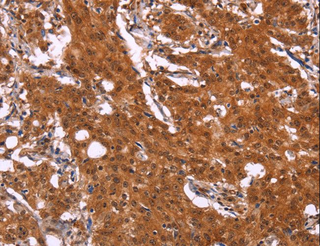 APMAP / C20orf3 Antibody - Immunohistochemistry of paraffin-embedded Human gastric cancer using APMAP Polyclonal Antibody at dilution of 1:30.