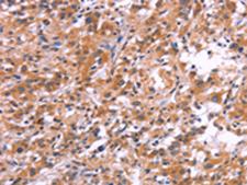 APMAP / C20orf3 Antibody - Immunohistochemistry of paraffin-embedded Human thyroid cancer tissue  using APMAP Polyclonal Antibody at dilution of 1:30(×200)