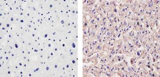APOA1 / Apolipoprotein A 1 Antibody - Immunohistochemistry analysis of Apolipoprotein A-1 showing staining in the cytoplasm of paraffin-embedded human liver tissue (right) compared to a negative control without primary antibody (left). To expose target proteins, antigen retrieval was performed using 10mM sodium citrate (pH 6.0), microwaved for 8-15 min. Following antigen retrieval, tissues were blocked in 3% H2O2-methanol for 15 min at room temperature, washed with ddH2O and PBS, and then probed with a Apolipoprotein A-1 Mouse Monoclonal Antibody. Proteins were transferred to a Nitrocellulose Membrane using the G2 Fast Blotter, and blocked with 5% milk in TBST for at least 1 hour at room temperature. Apo A-1 was detected at ~50kD using an Apolipoprotein A-1 monoclonal antibody at a dilution of 1:1000 in blocking buffer overnight at 4C on a rocking platform, followed by an HRP-conjugated goat anti-mouse IgG Fc-specific secondary antibody at a dilution of 1:40,000 for at least 30 minutes at room temperature. Chemiluminescent detection was performed using SuperSignal West Dura.