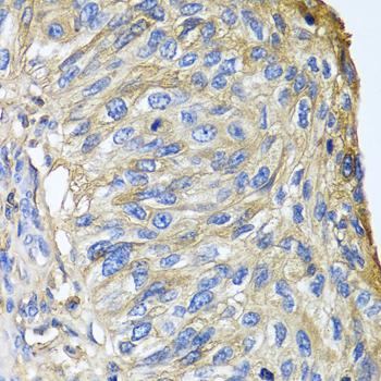 APOA1 / Apolipoprotein A 1 Antibody - Immunohistochemistry of paraffin-embedded Human prostate cancer using APOA1 Polyclonal Antibody at dilution of 1:100 (40x lens).