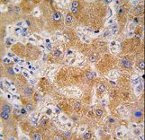 APOA4 Antibody - Formalin-fixed and paraffin-embedded human hepatocarcinoma tissue reacted with APOA4 antibody , which was peroxidase-conjugated to the secondary antibody, followed by DAB staining. This data demonstrates the use of this antibody for immunohistochemistry; clinical relevance has not been evaluated.