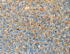 APOA4 Antibody - Immunohistochemistry of paraffin-embedded Human cervical cancer using APOA4 Polyclonal Antibody at dilution of 1:30.