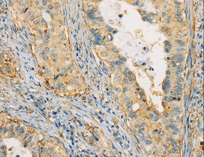 APOA4 Antibody - Immunohistochemistry of paraffin-embedded Human cervical cancer using APOA4 Polyclonal Antibody at dilution of 1:30.