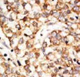 APOBEC1 Antibody - Formalin-fixed and paraffin-embedded human cancer tissue reacted with the primary antibody, which was peroxidase-conjugated to the secondary antibody, followed by DAB staining. This data demonstrates the use of this antibody for immunohistochemistry; clinical relevance has not been evaluated. BC = breast carcinoma; HC = hepatocarcinoma.