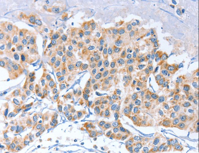 APOBEC3D Antibody - Immunohistochemistry of paraffin-embedded Human breast cancer using APOBEC3D Polyclonal Antibody at dilution of 1:80.