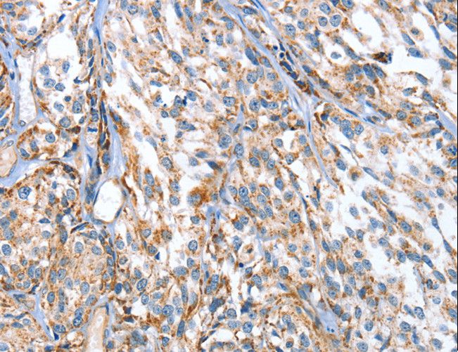 APOBEC3D Antibody - Immunohistochemistry of paraffin-embedded Human esophagus cancer using APOBEC3D Polyclonal Antibody at dilution of 1:80.