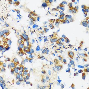 APOBEC3F / ARP8 Antibody - Immunohistochemistry of paraffin-embedded Human lung cancer using APOBEC3F Polyclonal Antibody at dilution of 1:100 (40x lens).