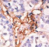 APOBEC3G / CEM15 Antibody - Formalin-fixed and paraffin-embedded human cancer tissue reacted with the primary antibody, which was peroxidase-conjugated to the secondary antibody, followed by AEC staining. This data demonstrates the use of this antibody for immunohistochemistry; clinical relevance has not been evaluated. BC = breast carcinoma; HC = hepatocarcinoma.
