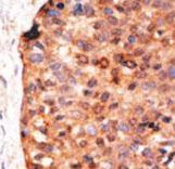APOBEC3G / CEM15 Antibody - Formalin-fixed and paraffin-embedded human cancer tissue reacted with the primary antibody, which was peroxidase-conjugated to the secondary antibody, followed by DAB staining. This data demonstrates the use of this antibody for immunohistochemistry; clinical relevance has not been evaluated. BC = breast carcinoma; HC = hepatocarcinoma.