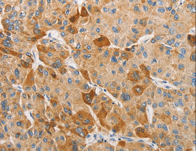 APOBEC3G / CEM15 Antibody - Immunohistochemistry of paraffin-embedded Human liver cancer using APOBEC3G Polyclonal Antibody at dilution of 1:50.