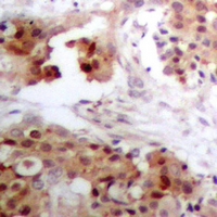 APOBEC3G / CEM15 Antibody - Immunohistochemical analysis of APOBEC3G staining in human breast cancer formalin fixed paraffin embedded tissue section. The section was pre-treated using heat mediated antigen retrieval with sodium citrate buffer (pH 6.0). The section was then incubated with the antibody at room temperature and detected using an HRP conjugated compact polymer system. DAB was used as the chromogen. The section was then counterstained with hematoxylin and mounted with DPX.