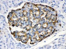 APOBEC3G / CEM15 Antibody - IHC testing of FFPE human pancreatic cancer tissue with APOBEC3G antibody at 1ug/ml. HIER: steam in pH6 citrate buffer and allow to cool prior to staining.