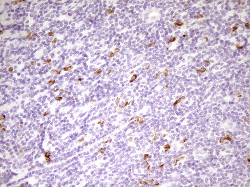 APOBR / APOB48R Antibody - Immunohistochemical staining of paraffin-embedded Carcinoma of Human prostate tissue using anti-APOBR mouse monoclonal antibody. (Heat-induced epitope retrieval by 1 mM EDTA in 10mM Tris, pH8.5, 120C for 3min,