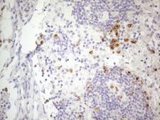 APOBR / APOB48R Antibody - Immunohistochemical staining of paraffin-embedded Carcinoma of Human thyroid tissue using anti-APOBR mouse monoclonal antibody. (Heat-induced epitope retrieval by 1mM EDTA in 10mM Tris buffer. (pH8.5) at 120°C for 3 min. (1:150)