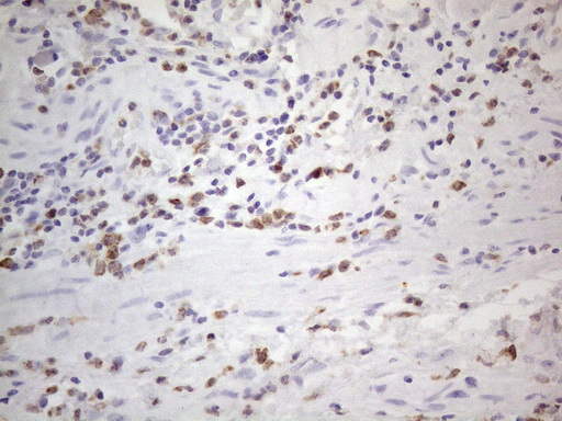 APOBR / APOB48R Antibody - Immunohistochemical staining of paraffin-embedded Carcinoma of Human bladder tissue using anti-APOBR mouse monoclonal antibody. (Heat-induced epitope retrieval by 1mM EDTA in 10mM Tris buffer. (pH8.5) at 120°C for 3 min. (1:150)