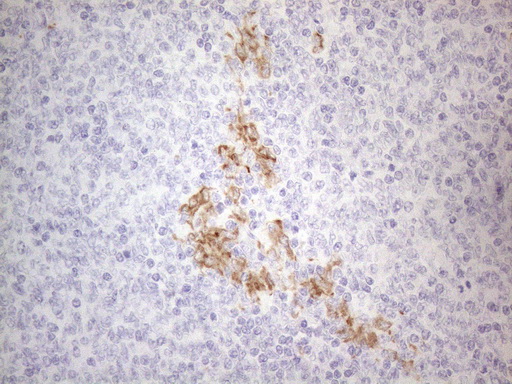 APOBR / APOB48R Antibody - Immunohistochemical staining of paraffin-embedded Human lymphoma tissue using anti-APOBR mouse monoclonal antibody. (Heat-induced epitope retrieval by 1mM EDTA in 10mM Tris buffer. (pH8.5) at 120°C for 3 min. (1:150)