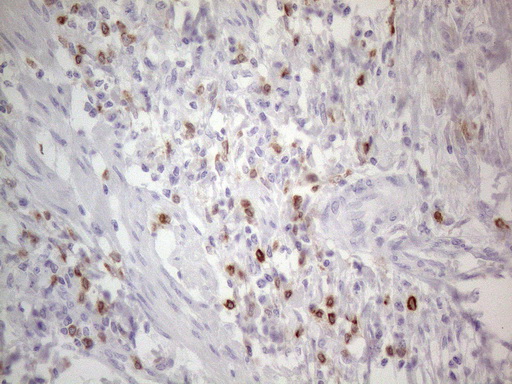 APOBR / APOB48R Antibody - Immunohistochemical staining of paraffin-embedded Adenocarcinoma of Human colon tissue using anti-APOBR mouse monoclonal antibody. (Heat-induced epitope retrieval by 1mM EDTA in 10mM Tris buffer. (pH8.5) at 120°C for 3 min. (1:150)