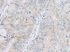 APOBR / APOB48R Antibody - Immunohistochemistry of paraffin-embedded Human colorectal cancer tissue  using APOBR Polyclonal Antibody at dilution of 1:35(×200)