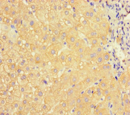 APOC3 / Apolipoprotein C III Antibody - Immunohistochemistry of paraffin-embedded human liver cancer at dilution of 1:100