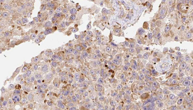 APOC3 / Apolipoprotein C III Antibody - 1:100 staining human Melanoma tissue by IHC-P. The sample was formaldehyde fixed and a heat mediated antigen retrieval step in citrate buffer was performed. The sample was then blocked and incubated with the antibody for 1.5 hours at 22°C. An HRP conjugated goat anti-rabbit antibody was used as the secondary.