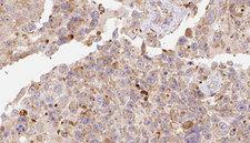APOC3 / Apolipoprotein C III Antibody - 1:100 staining human Melanoma tissue by IHC-P. The sample was formaldehyde fixed and a heat mediated antigen retrieval step in citrate buffer was performed. The sample was then blocked and incubated with the antibody for 1.5 hours at 22°C. An HRP conjugated goat anti-rabbit antibody was used as the secondary.