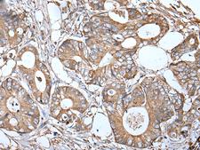 APOD / Apolipoprotein D Antibody - Immunohistochemistry of paraffin-embedded Human colorectal cancer tissue  using APOD Polyclonal Antibody at dilution of 1:55(×200)