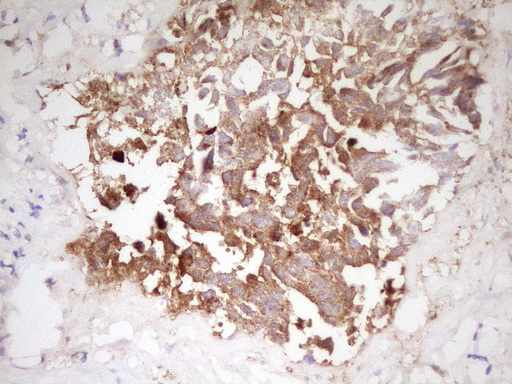 APOE / Apolipoprotein E Antibody - Immunohistochemical staining of paraffin-embedded Human testicular cancer tissue using anti-APOE mouse monoclonal antibody. (Heat-induced epitope retrieval by 1 mM EDTA in 10mM Tris, pH8.5, 120C for 3min,