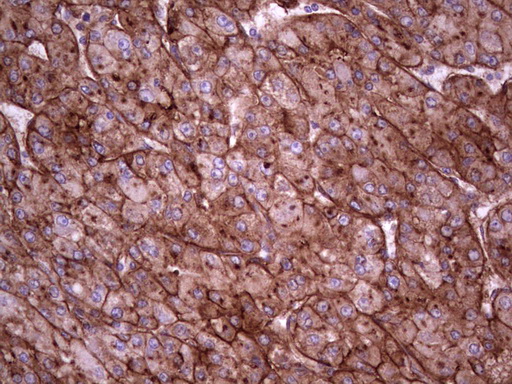 APOE / Apolipoprotein E Antibody - IHC of paraffin-embedded Carcinoma of Human liver tissue using anti-APOE mouse monoclonal antibody. (Heat-induced epitope retrieval by 1 mM EDTA in 10mM Tris, pH8.5, 120°C for 3min).