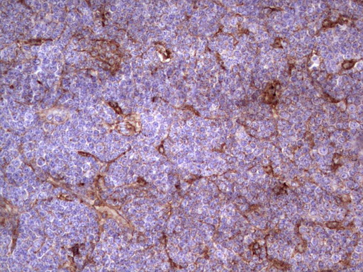APOE / Apolipoprotein E Antibody - IHC of paraffin-embedded Human lymphoma tissue using anti-APOE mouse monoclonal antibody. (Heat-induced epitope retrieval by 1 mM EDTA in 10mM Tris, pH8.5, 120°C for 3min).