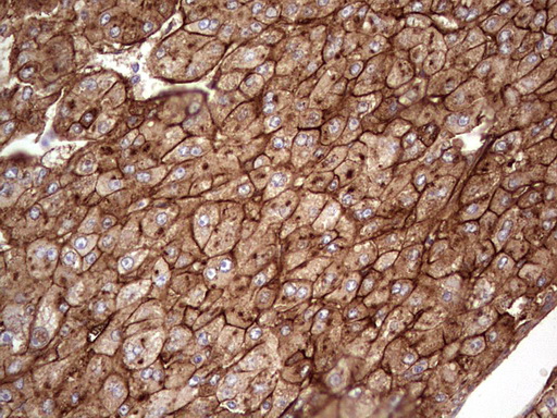 APOE / Apolipoprotein E Antibody - IHC of paraffin-embedded Carcinoma of Human liver tissue using anti-APOE mouse monoclonal antibody. (Heat-induced epitope retrieval by 1 mM EDTA in 10mM Tris, pH8.5, 120°C for 3min).