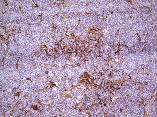 APOE / Apolipoprotein E Antibody - IHC of paraffin-embedded Human lymphoma tissue using anti-APOE mouse monoclonal antibody. (Heat-induced epitope retrieval by 1 mM EDTA in 10mM Tris, pH8.5, 120°C for 3min).