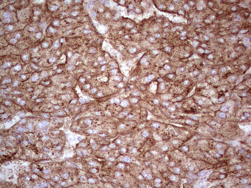 APOE / Apolipoprotein E Antibody - Immunohistochemical staining of paraffin-embedded Carcinoma of Human liver tissue using anti-APOE mouse monoclonal antibody. (Heat-induced epitope retrieval by 1 mM EDTA in 10mM Tris, pH8.5, 120C for 3min,