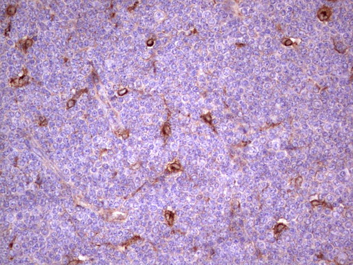 APOE / Apolipoprotein E Antibody - Immunohistochemical staining of paraffin-embedded Human lymphoma tissue using anti-APOE mouse monoclonal antibody. (Heat-induced epitope retrieval by 1 mM EDTA in 10mM Tris, pH8.5, 120C for 3min,