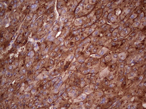 APOE / Apolipoprotein E Antibody - Immunohistochemical staining of paraffin-embedded Carcinoma of Human liver tissue using anti-APOE mouse monoclonal antibody. (Heat-induced epitope retrieval by 1 mM EDTA in 10mM Tris, pH8.5, 120C for 3min,