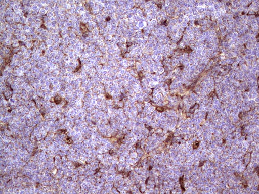 APOE / Apolipoprotein E Antibody - Immunohistochemical staining of paraffin-embedded Human lymphoma tissue using anti-APOE mouse monoclonal antibody. (Heat-induced epitope retrieval by 1 mM EDTA in 10mM Tris, pH8.5, 120C for 3min,
