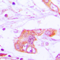 APOE / Apolipoprotein E Antibody - Immunohistochemical analysis of Apolipoprotein E staining in human lung cancer formalin fixed paraffin embedded tissue section. The section was pre-treated using heat mediated antigen retrieval with sodium citrate buffer (pH 6.0). The section was then incubated with the antibody at room temperature and detected using an HRP conjugated compact polymer system. DAB was used as the chromogen. The section was then counterstained with hematoxylin and mounted with DPX.