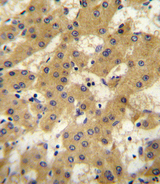 APOF / Apolipoprotein F Antibody - APOF antibody immunohistochemistry of formalin-fixed and paraffin-embedded human hepatocarcinoma followed by peroxidase-conjugated secondary antibody and DAB staining.