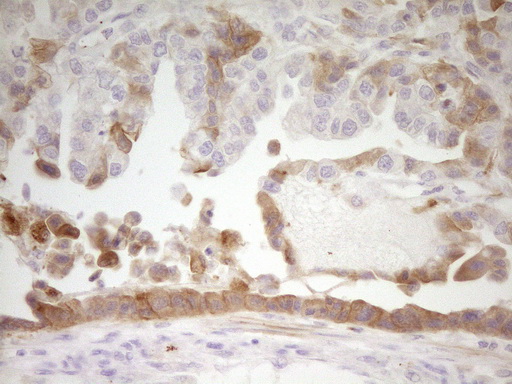 APOH / Apolipoprotein H Antibody - Immunohistochemical staining of paraffin-embedded Adenocarcinoma of Human ovary tissue using anti-APOH mouse monoclonal antibody. (Heat-induced epitope retrieval by 1 mM EDTA in 10mM Tris, pH8.5, 120C for 3min,