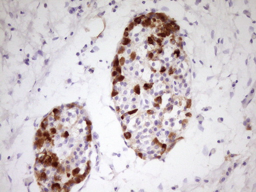 APOH / Apolipoprotein H Antibody - Immunohistochemical staining of paraffin-embedded Carcinoma of Human pancreas tissue using anti-APOH mouse monoclonal antibody. (Heat-induced epitope retrieval by 1 mM EDTA in 10mM Tris, pH8.5, 120C for 3min,