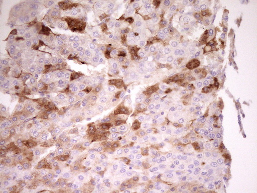 APOH / Apolipoprotein H Antibody - Immunohistochemical staining of paraffin-embedded Carcinoma of Human liver tissue using anti-APOH mouse monoclonal antibody. (Heat-induced epitope retrieval by 1 mM EDTA in 10mM Tris, pH8.5, 120C for 3min,