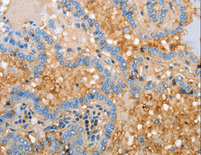 APOH / Apolipoprotein H Antibody - Immunohistochemistry of paraffin-embedded Human thyroid cancer using APOH Polyclonal Antibody at dilution of 1:30.