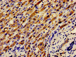 APOH / Apolipoprotein H Antibody - Immunohistochemistry image of paraffin-embedded human liver cancer at a dilution of 1:100