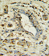 APOL1 / Apolipoprotein L Antibody - APOL1 Antibody IHC of formalin-fixed and paraffin-embedded human breast carcinoma followed by peroxidase-conjugated secondary antibody and DAB staining.