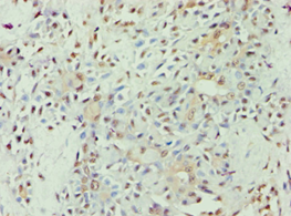 APOL1 / Apolipoprotein L Antibody - Immunohistochemistry of paraffin-embedded human breast cancer using antibody at 1:100 dilution.